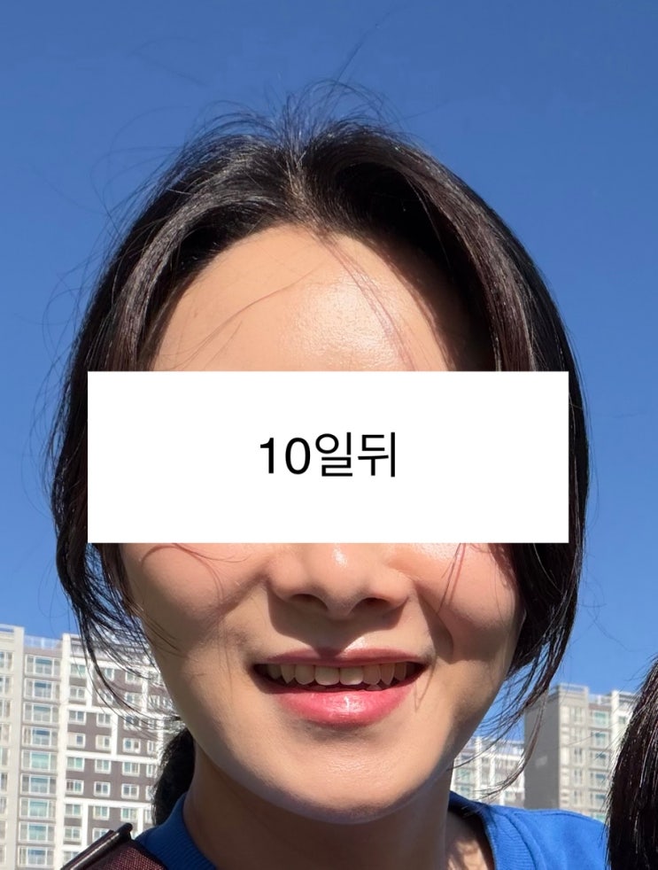  스킨보톡스+리쥬란2cc 한달경과 후기