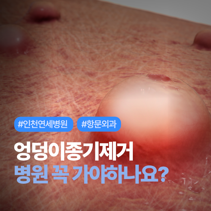 인천 엉덩이종기제거병원 꼭 가야하나요?? 셀프로 제거하면 안되나요?