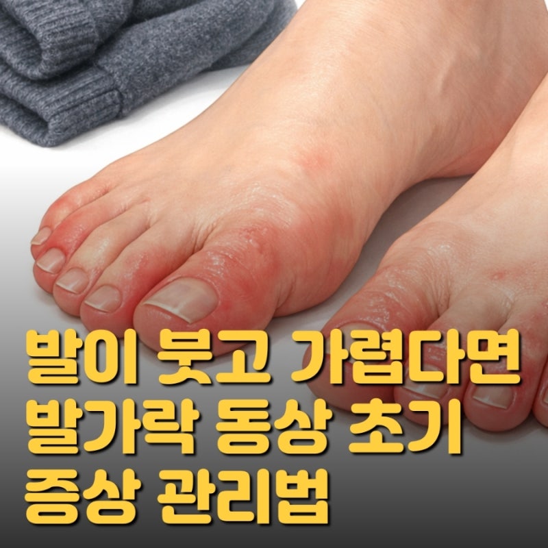 발가락 동상 증상 치료 병원, 발동상 가려움 연고 치료법