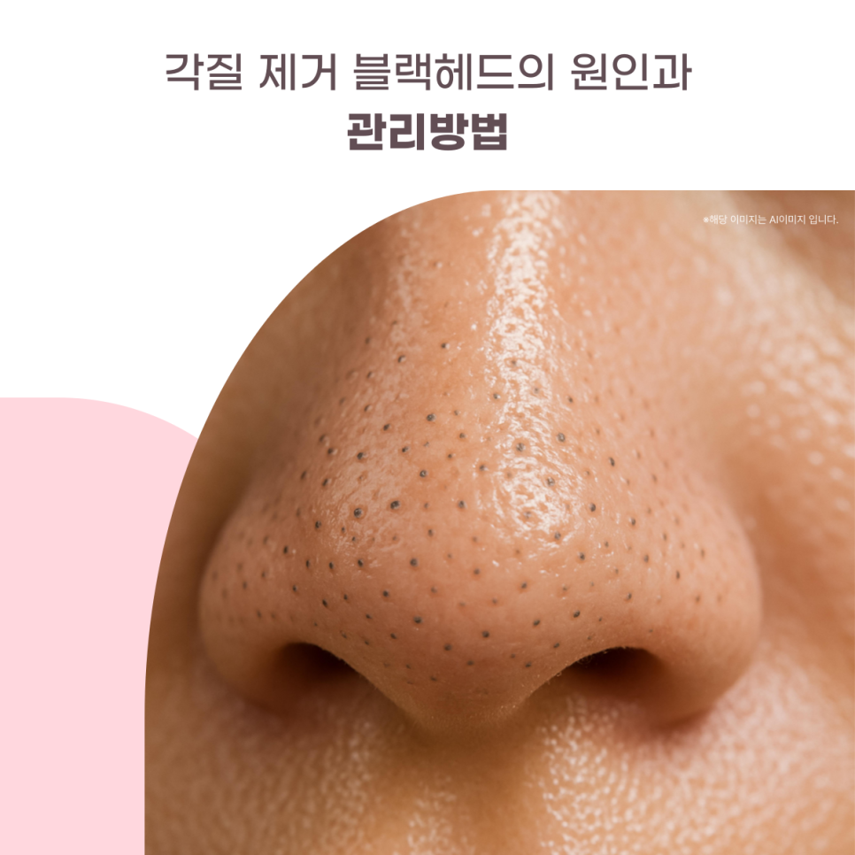 각질 제거 블랙헤드의 원인과 관리법 대표 이미지