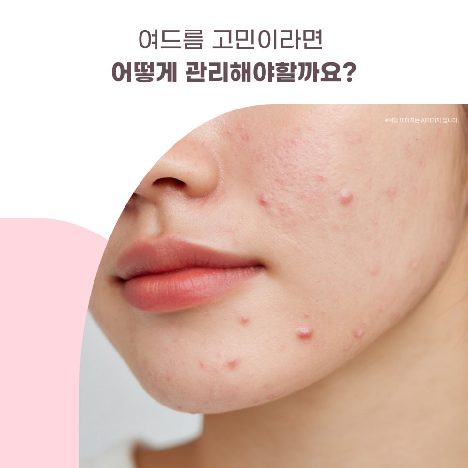 여드름 고민이라면 어떻게 관리해야할까요? 대표 이미지