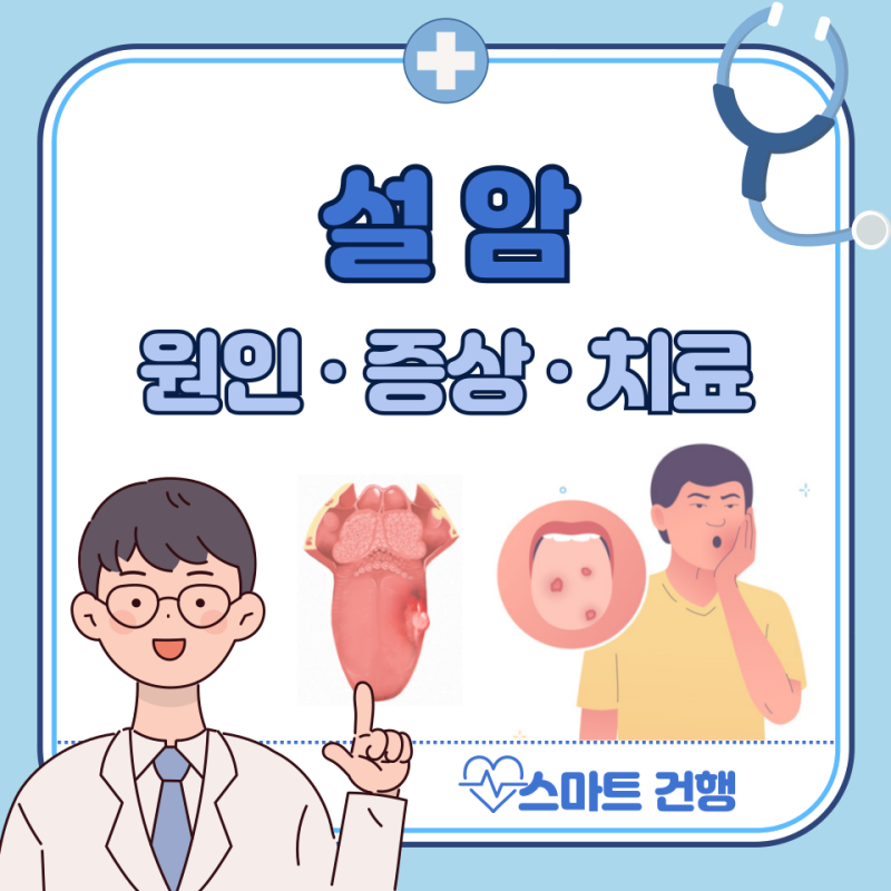 설암 초기 증상, 원인, 치료 방법, 수술 : 생존율, 병원 어디로