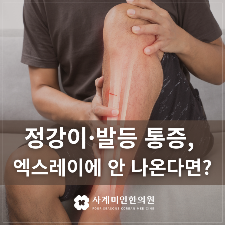  운중동통증한의원 | 정강이·발등 통증, 엑스레이에 안 나온다면? 공공데이터로 본 피로골절 증상과 회복법