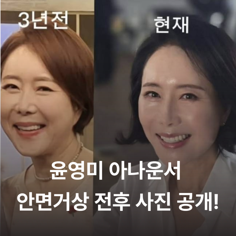 윤영미 아나운서 안면거상 전후 사진 공개! 60대 회춘의 비밀은? (효과, 비용, 주의사항)