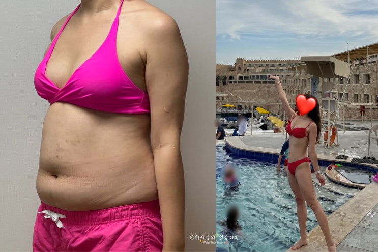 복부지방흡입 붓기 멍 통증 흉터 가격 정보 총 정리