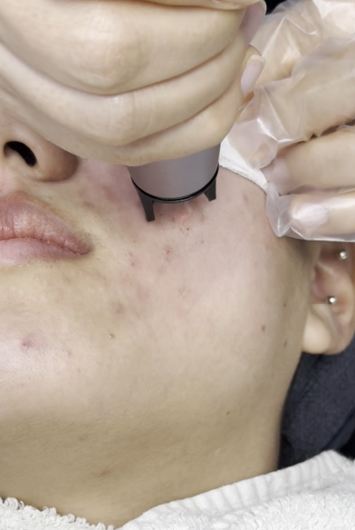  Essence of Scar Treatment / 跡治療の本質 / 疤痕修复的本质