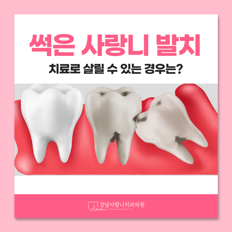 강남사랑니치과 썩은 사랑니 발치, 치료로 살릴 수 있는 경우는?