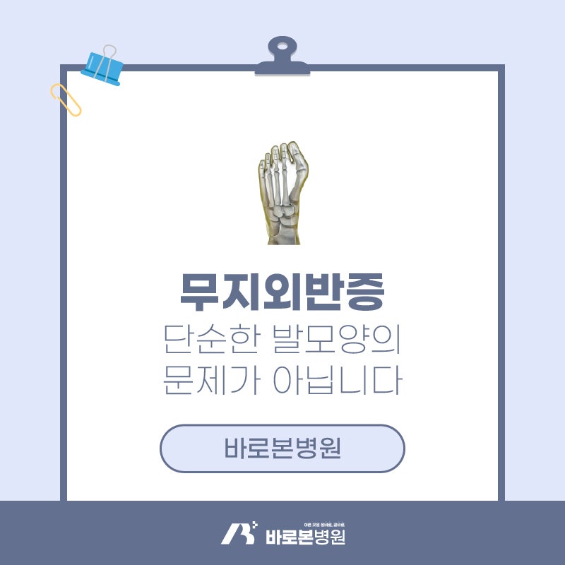 무지외반증, 단순한 발 모양 문제가 아닙니다::대전정형외과 바로본병원