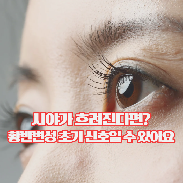  황반변성 증상 초기 신호, 시야가 흐려지기 시작했다면