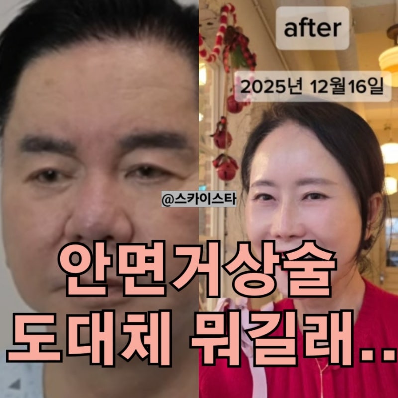 63세 윤영미 안면거상술 심형래도 두번한 이 수술 정체 정말 괜찮을까?
