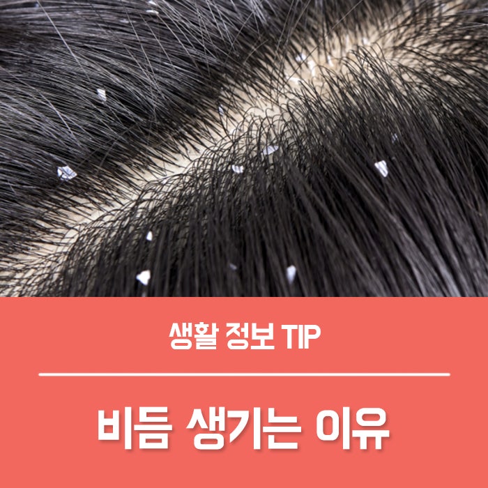 니조랄 샴푸 약국 가격, 머리 비듬약 효과 사용법 비듬생기는이유는?