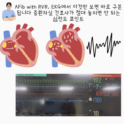 AFib with RVR, EKG에서 이것만 보면 바로 구분됩니다 중환자실 간호사가 절대 놓치면 안 되는 심전도 포인트 ...