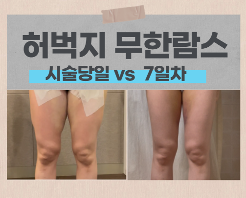  성신여대 허벅지 지방추출주사 당일 ~7일차 변화