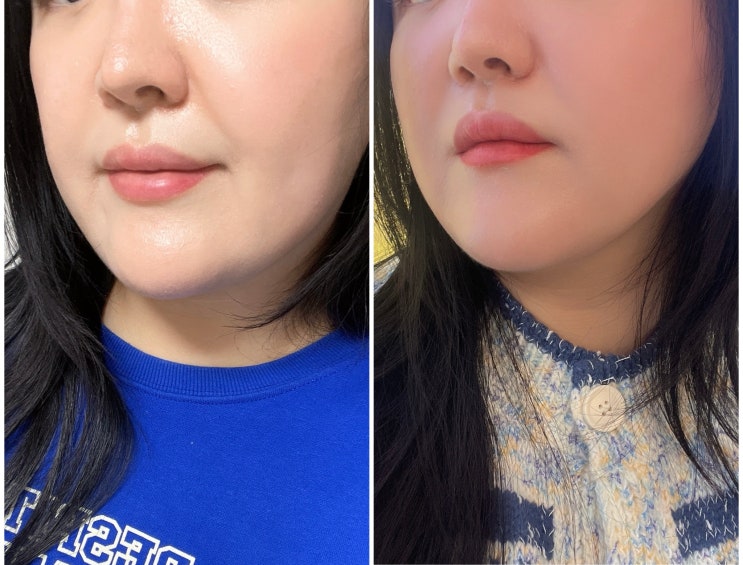  남천동 피부관리 신에스테틱 온다리프팅 전후 비교