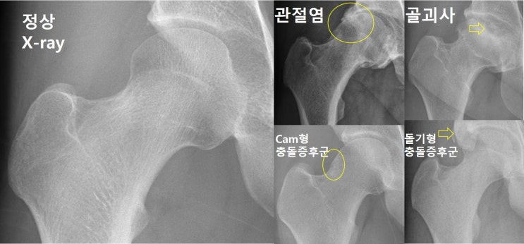  고관절 유착성 관절낭염(고관절 ‘오십견’) - 이렇게 진단합니다.