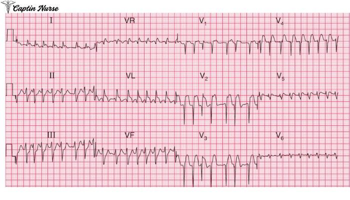 AFib with RVR, EKG에서 이것만 보면 바로 구분됩니다 중환자실 간호사가 절대 놓치면 안 되는 심전도 포인트 ...