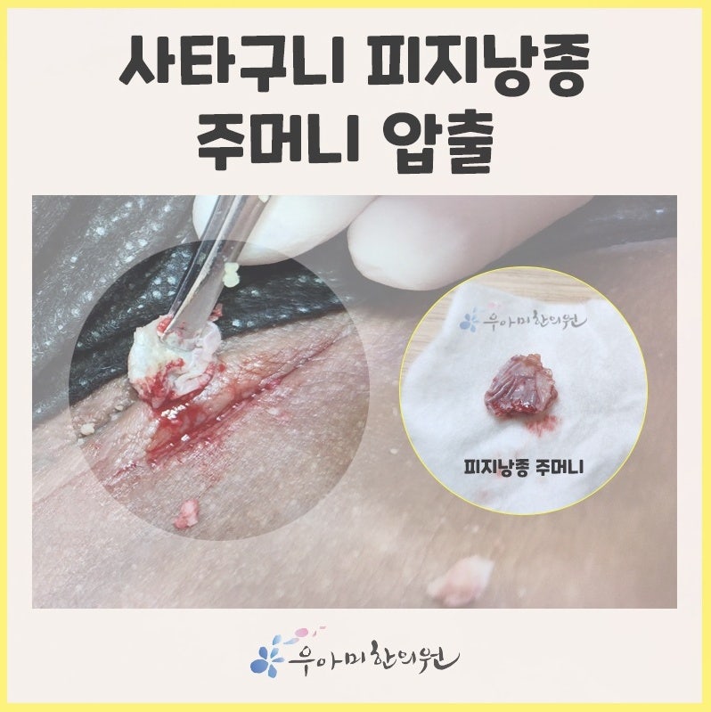 여자 생식기 여드름·회음부 멍울, 짜도 될까? 종기·낭종과 구분하는 기준