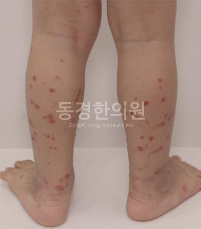 HS자반증 증상 치료 및 알레르기혈관염 신장 합병증 예방하려면
