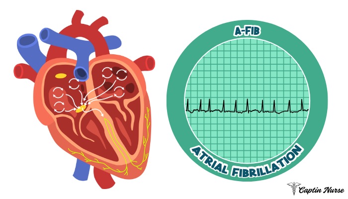 AFib with RVR, EKG에서 이것만 보면 바로 구분됩니다 중환자실 간호사가 절대 놓치면 안 되는 심전도 포인트 ...