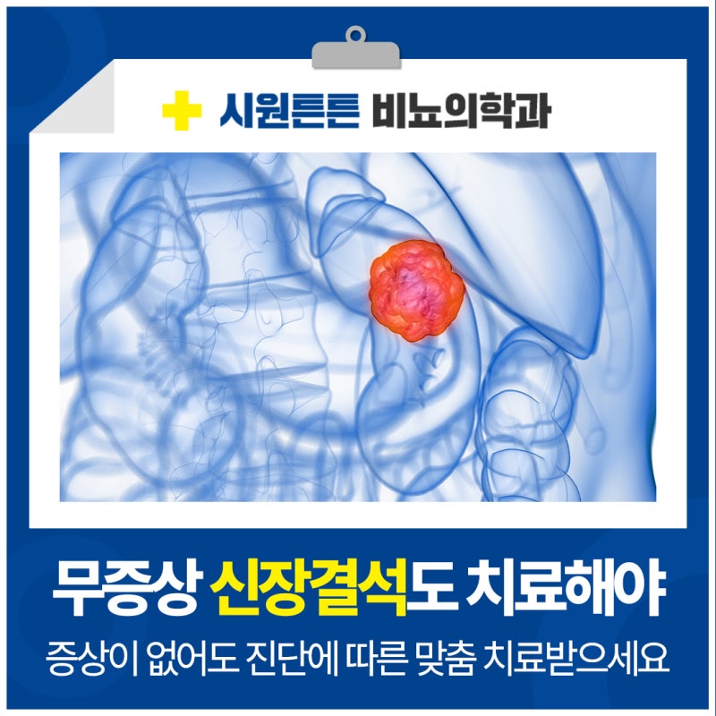 대전 신장결석 병원, 증상이 없는데 우연히 발견했다면 꼭 치료하세요