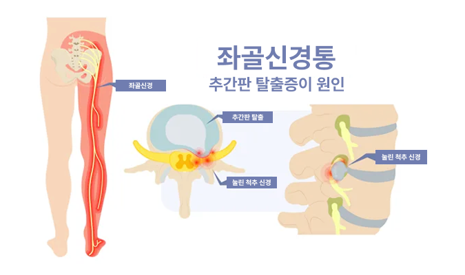  좌골신경통이라 불리는 다리저림, 요추 신경근병증 한눈 정리 부산허리재활병원
