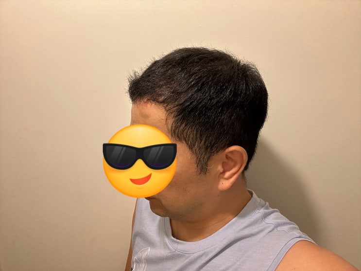  터키 모발이식 드디어 1년차 세번째 후기입니다 :)