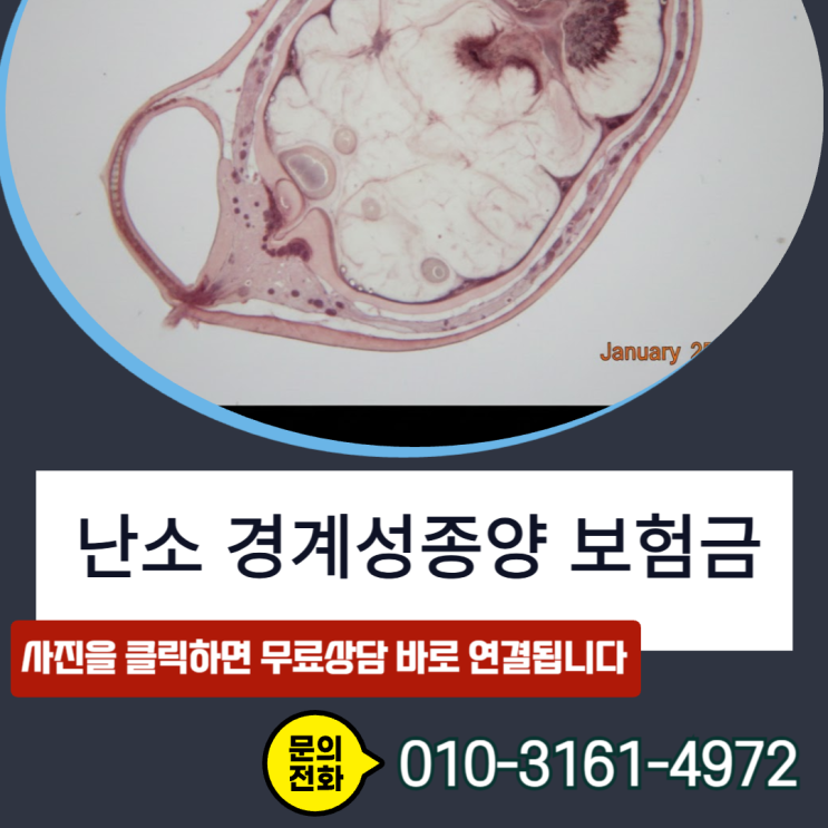  난소 경계성종양 암진단비, 소액암20%만 받으셨나요? 손해사정사가 폭로하는 전액 보상의 진실