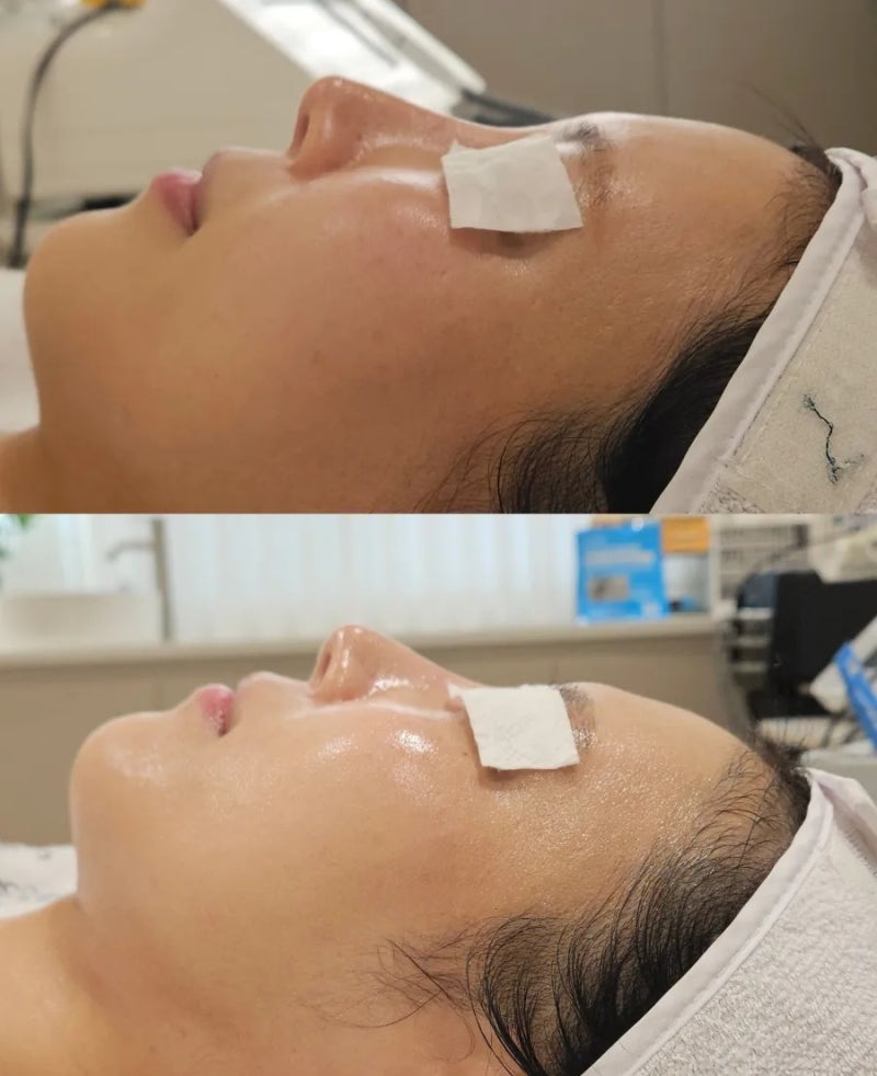 광주 파메스테틱 수완지구 홍조피부관리 고민정피부연구소 피부가 숨쉴수 있는 곳
