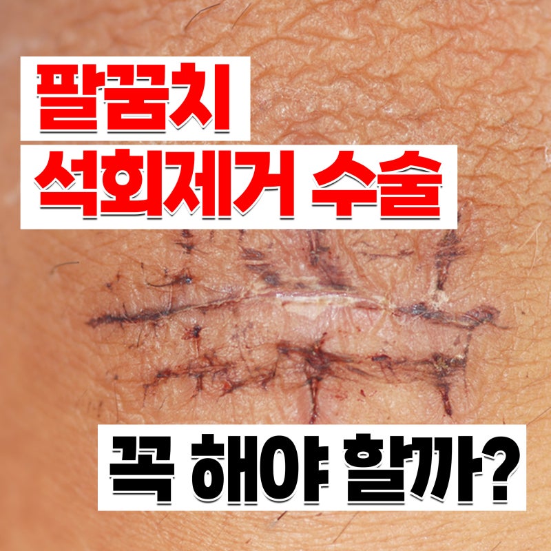 팔꿈치 석회제거 수술 [테니스/ 골프엘보 팔꿈치 염증] 꼭 해야 할까?