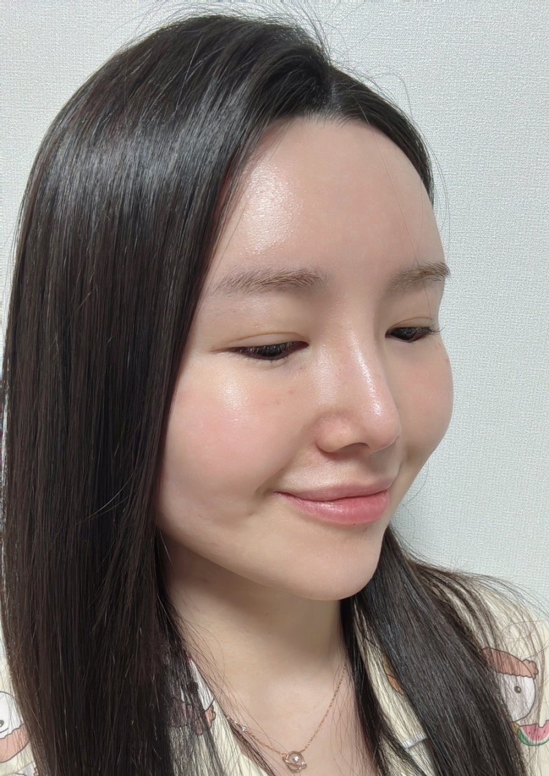 [ 비립종/편평사마귀제거] |Co2 레이저 제거 성지 후기 / 경과
