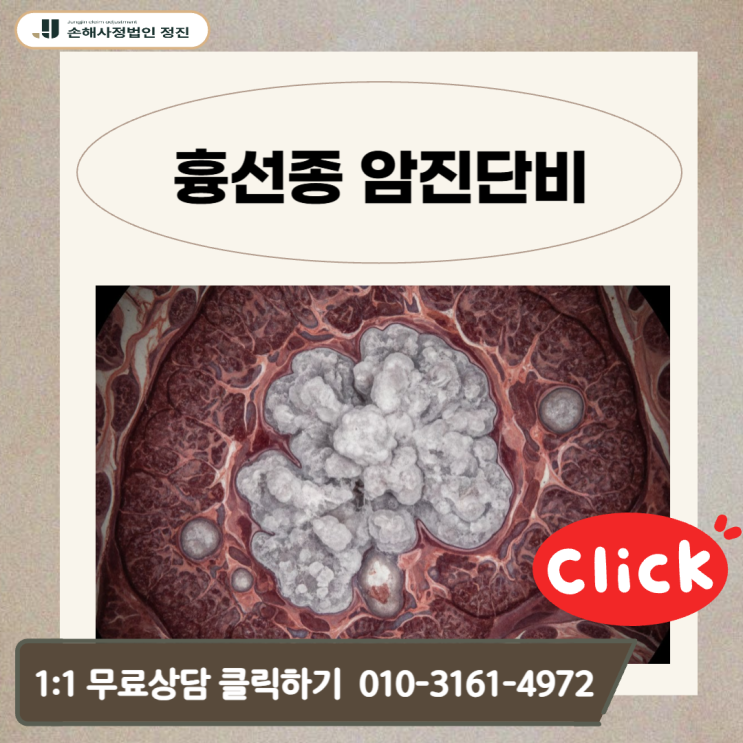  흉선종 암진단비 거절당하셨나요? 손해사정사가 밝히는 보험금 전액 수령의 비결