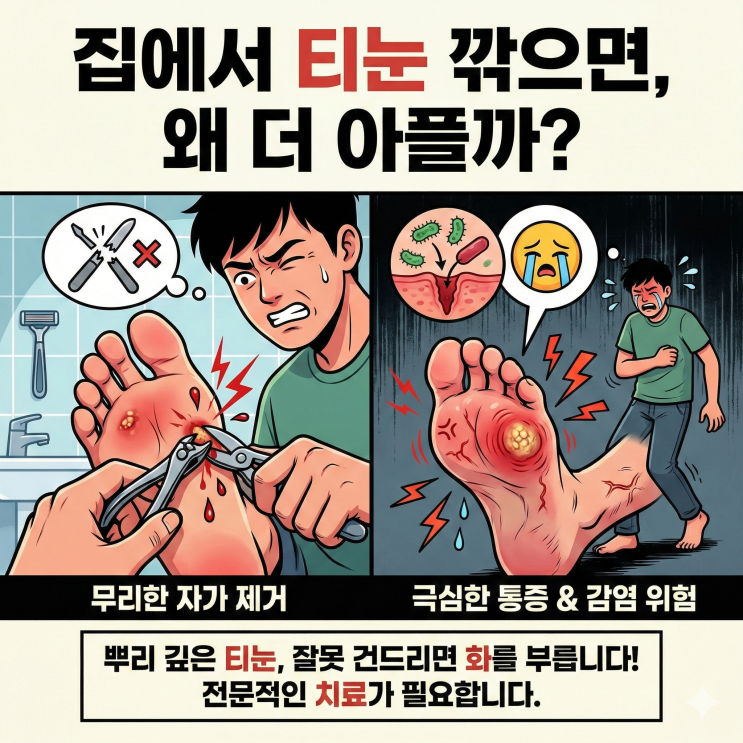 발바닥 티눈 병원 집에서 깎다 더 아파진 이유