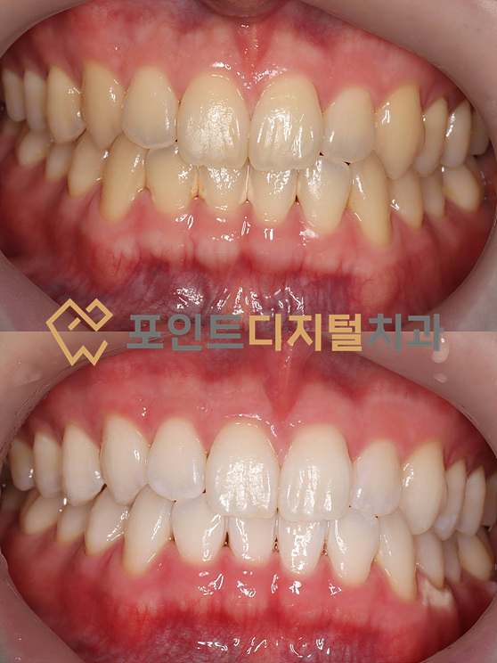  [탕정치과]  치아미백 A3.5의 어두운 미소에서 투명한 우윳빛 미소로!(미백폭발 코스) / 천안 아산 불당 배방