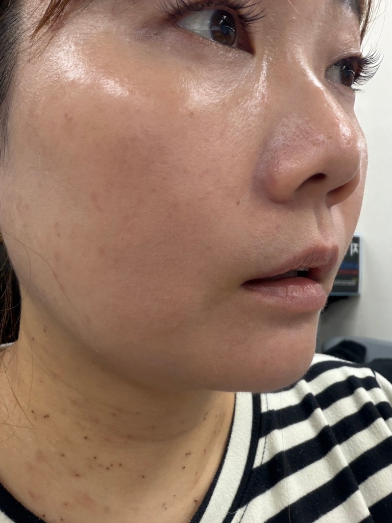 대구편평사마귀제거 대구쥐젖제거 대구편평사마귀무제한 받고 느낀 대구편평사마귀성지 찐....