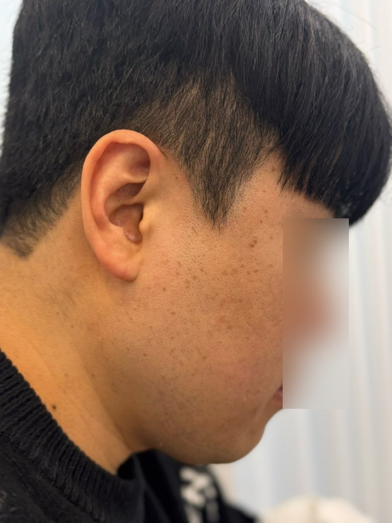 대구쥐젖제거 한의원 편평사마귀무제한 성지 후기
