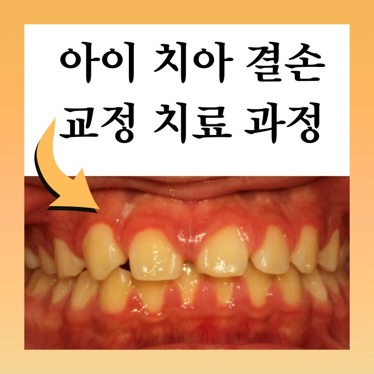  상계역 치아교정, 아이 치아 결손을 교정으로 해결한 과정