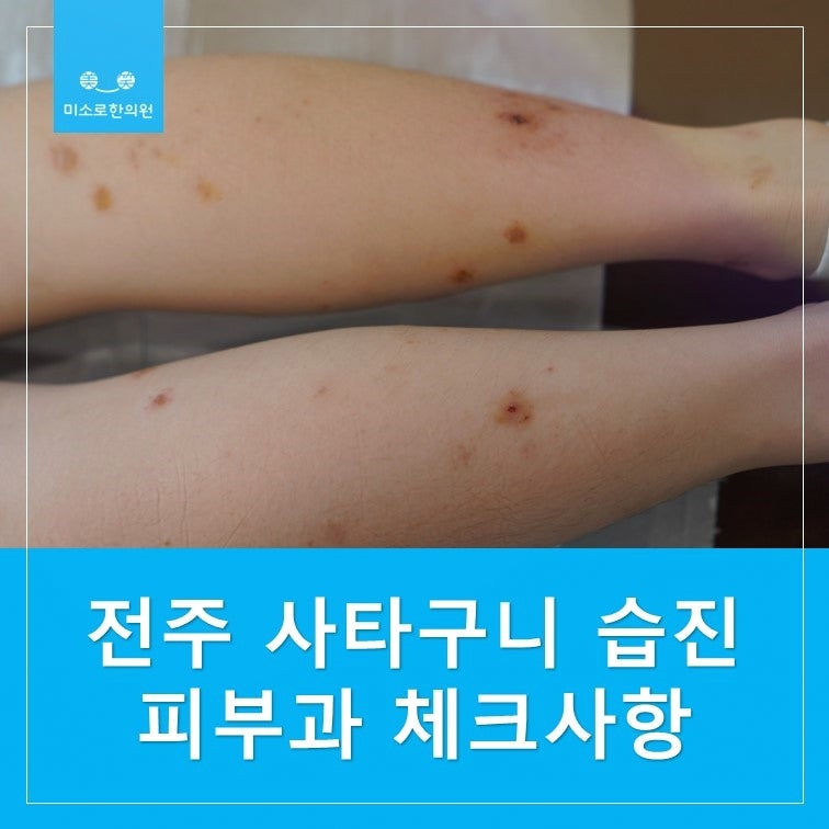 전주 사타구니 습진 피부과 하루 10시간 앉아있다면 체크하세요
