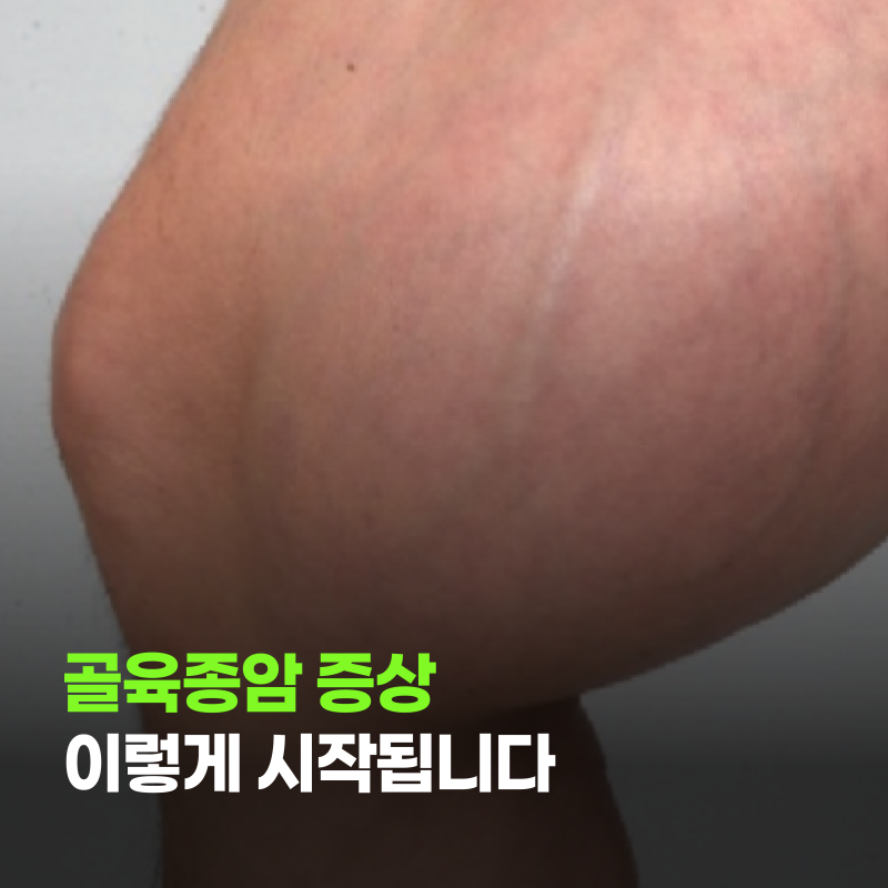 골육종암 증상 이렇게 시작됩니다