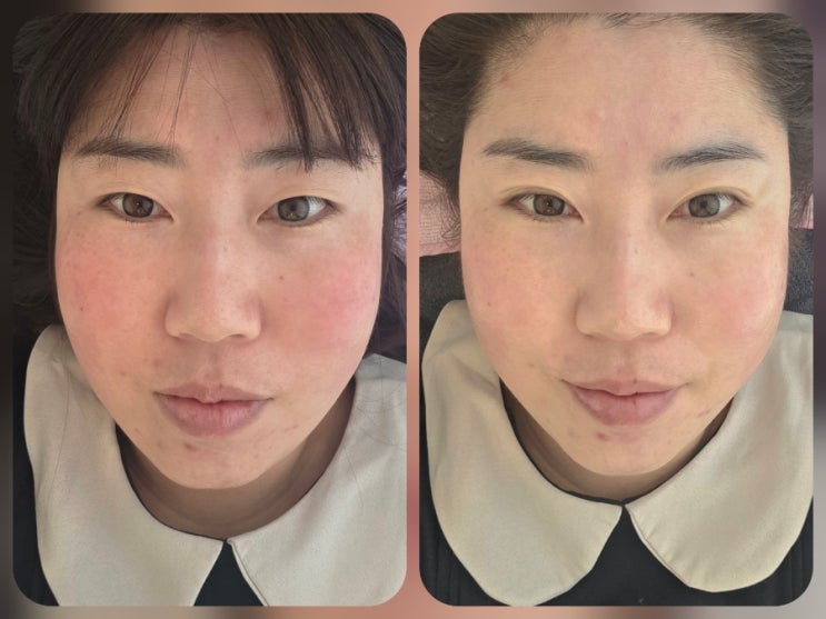  [정관]열오른 홍조피부 진정케어로 딱 좋은 정관에스테틱 '코엘뷰티'