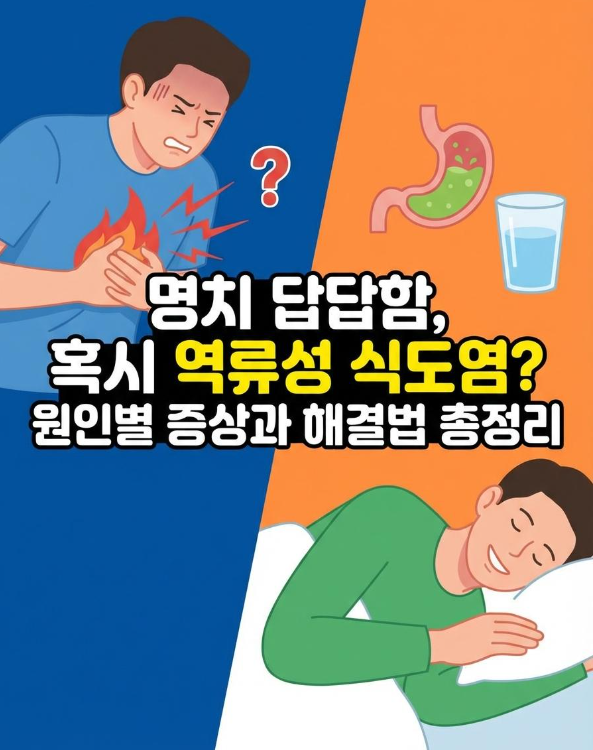 명치 답답함, 혹시 역류성 식도염?원인별 증상부터 집에서 바로 해보는 해결법까지 총정리