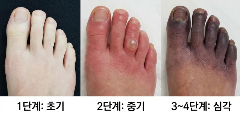 손가락 동상 발가락 동상 증상, 동상치료병원은 외과입니다
