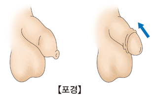 감돈포경·귀두포피염으로 인한 성인 포경수술, 실비와 질병수술비 받을 수 있나?