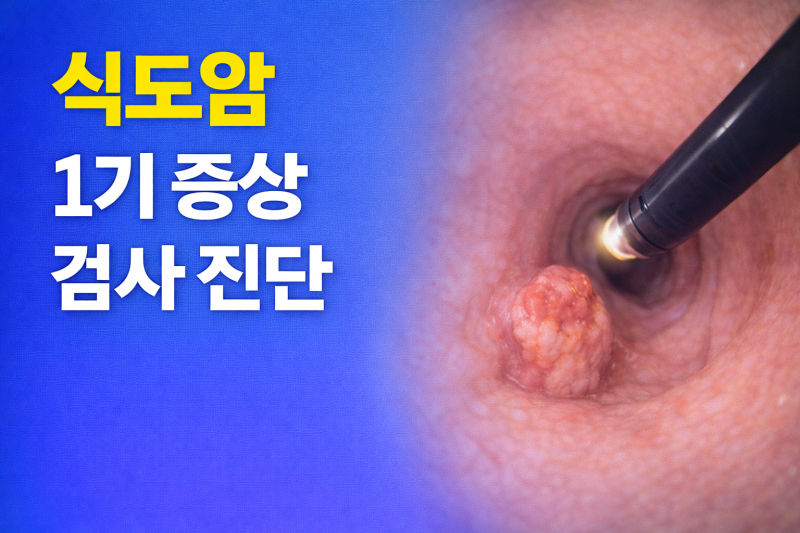식도암 1기 증상 검사 진단, 놓치기 쉬운 초기 신호 정리