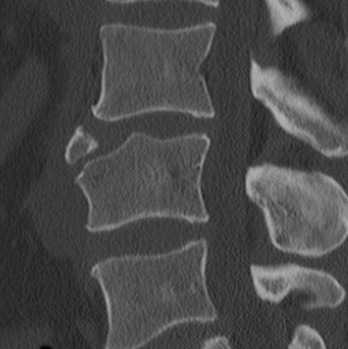 X-ray에 뼈조각이 보인다면 골절인가요? — 본문 그림