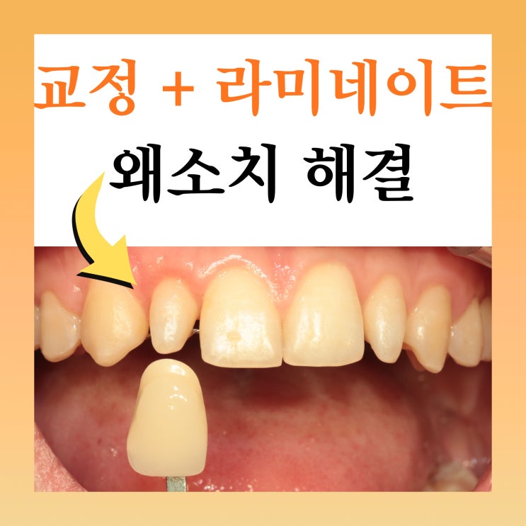  노원 라미네이트, 왜소치 교정 후 치료 사례