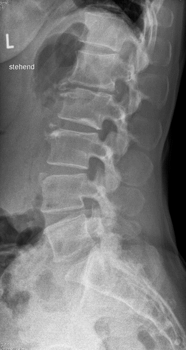 X-ray에 뼈조각이 보인다면 골절인가요? — 본문 그림