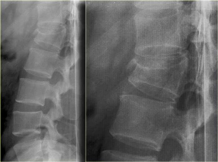 X-ray에 뼈조각이 보인다면 골절인가요? — 본문 그림