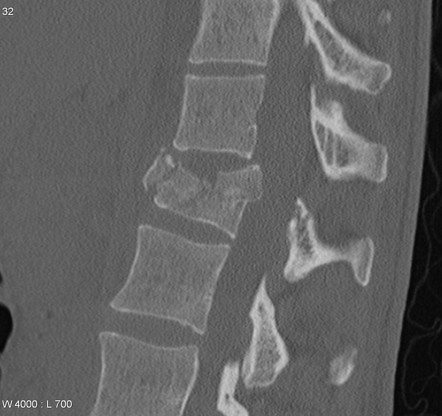 X-ray에 뼈조각이 보인다면 골절인가요? — 본문 그림