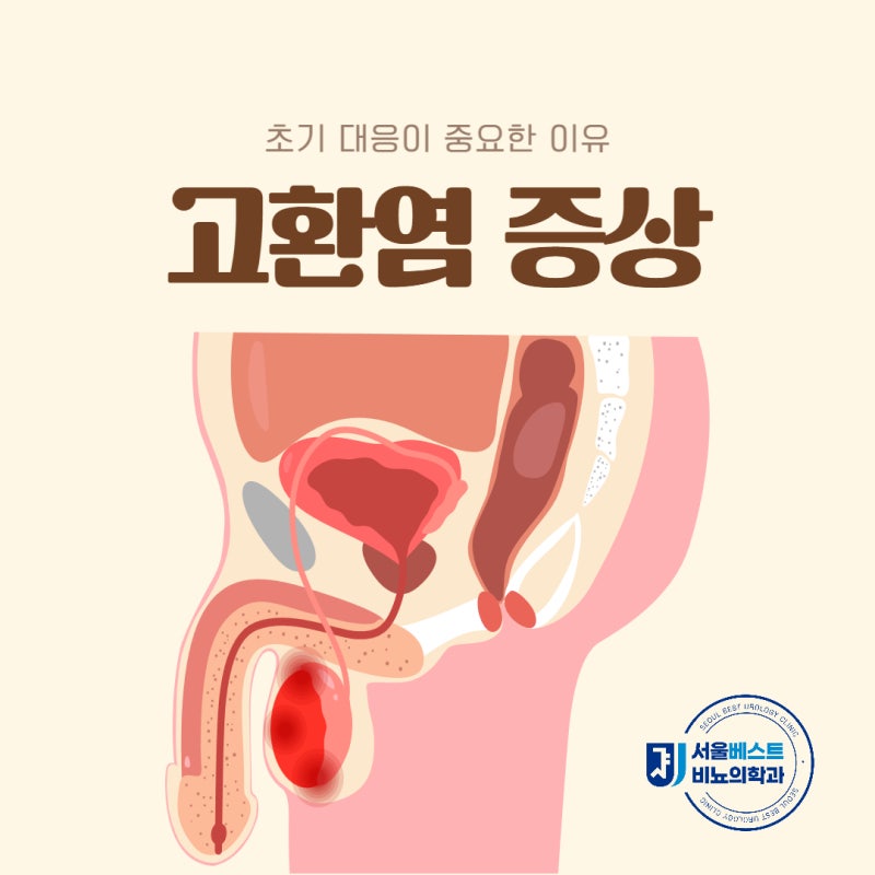 고환염 증상 초기 대응이 중요한 이유는