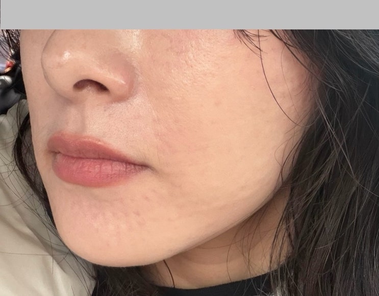  물광주사+스킨보톡스 2주 리얼후기｜자연광나는 피부결 변화